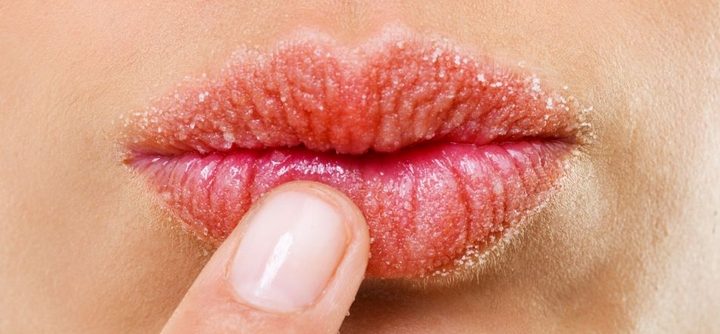 Comment soigner des lèvres gercées ?