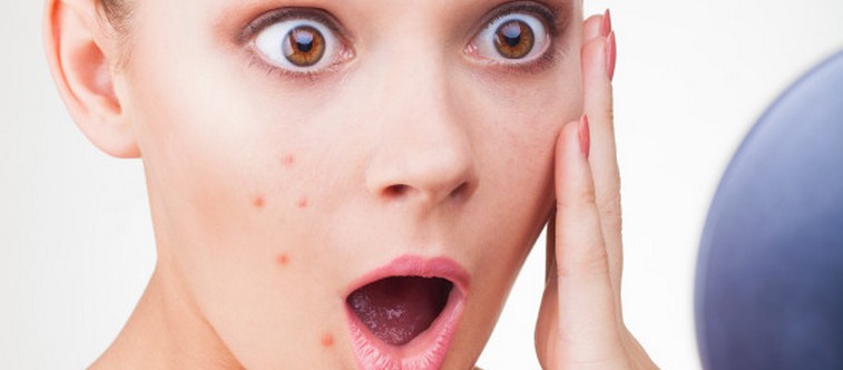Les mauvais réflexes à oublier quand on a de l’acné
